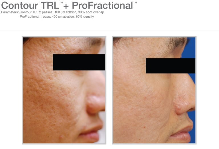 MLP-Profractional