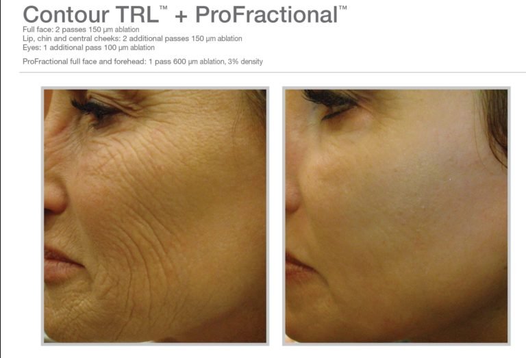 MLP-Profractional-Profractional-and-Contour