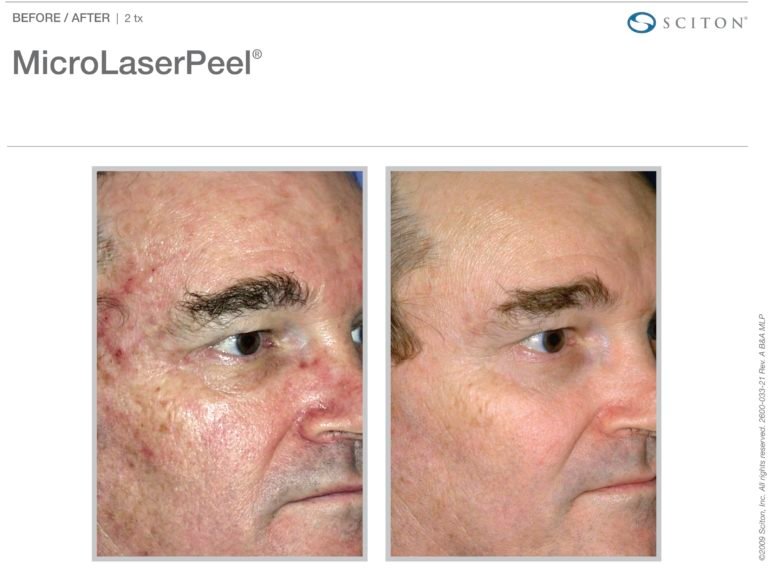 MicroLaserPeel-MLP