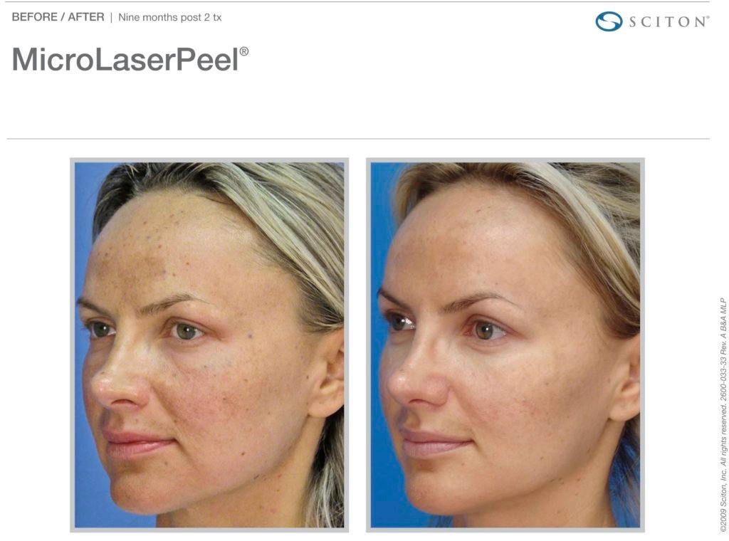 MicroLaserPeel-MLP