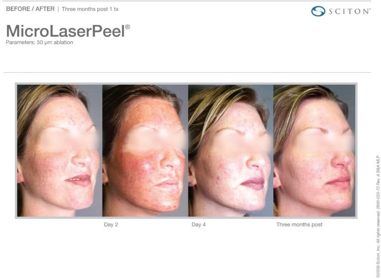 MicroLaserPeel-MLP