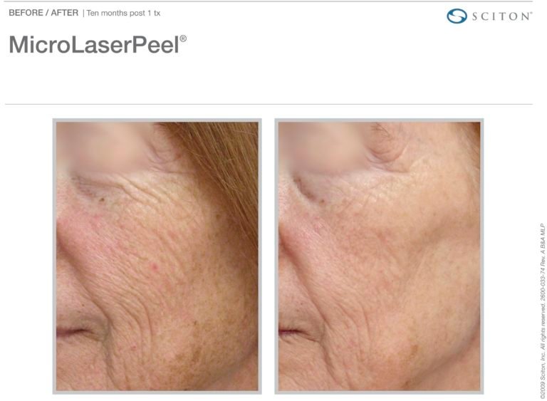 MicroLaserPeel-MLP