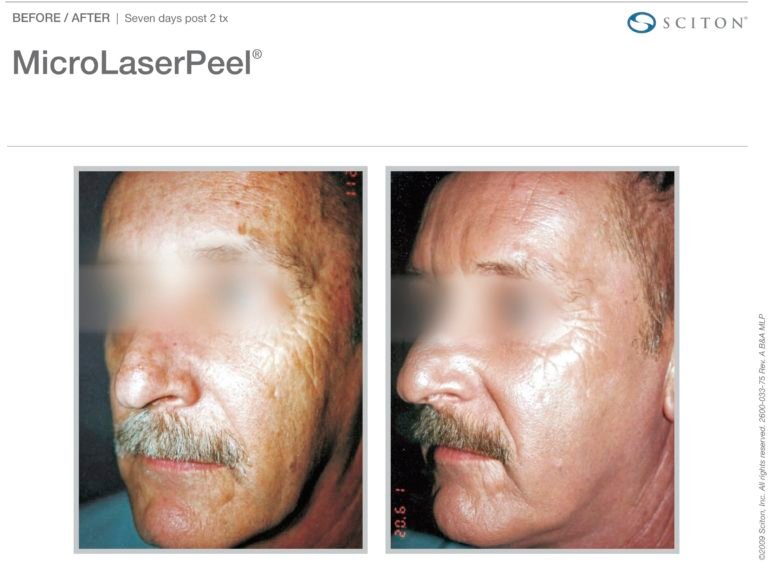 MicroLaserPeel-MLP