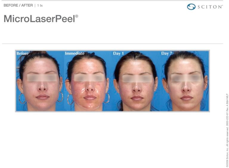 MicroLaserPeel-MLP