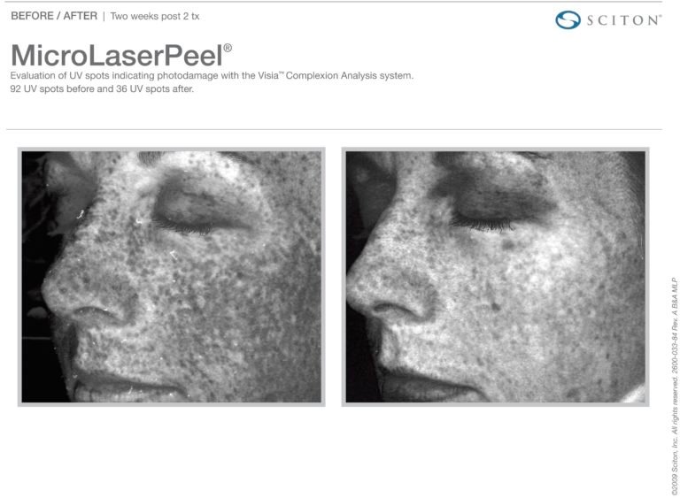 MicroLaserPeel-MLP