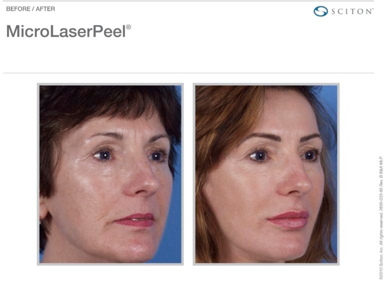 MicroLaserPeel-MLP