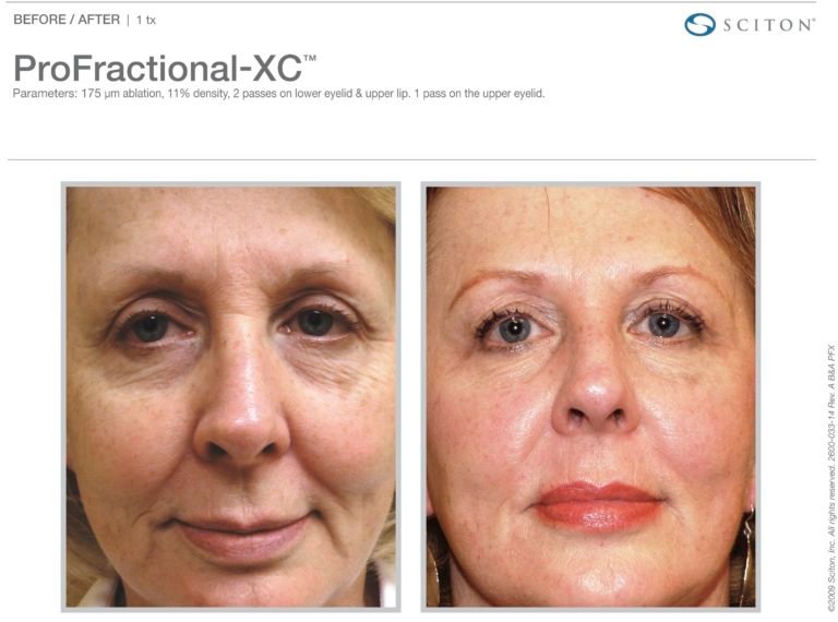 Profractional-BA-ProFXC