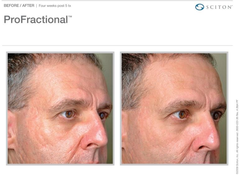 Profractional-BA