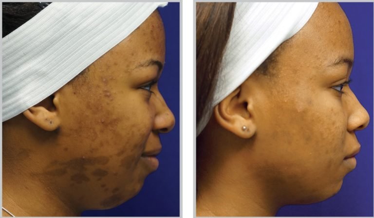 Profractional-BA-puremd