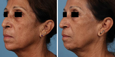 Before & After Archive - PureMD