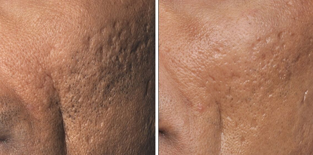 Before & After Archive - PureMD