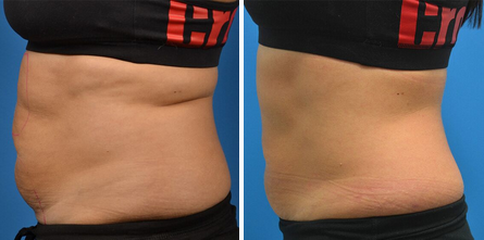 Before & After Archive - PureMD