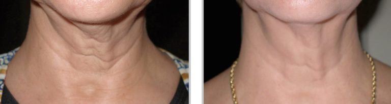 SkinTyte