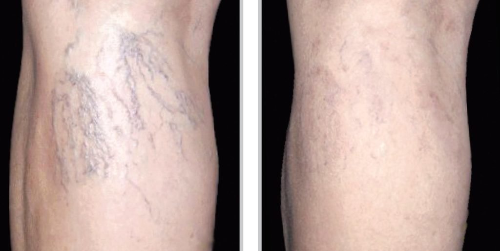Sclerotherapy