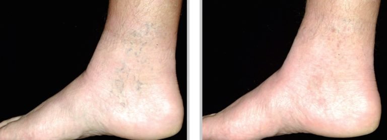 Veins-laser-veins-removal