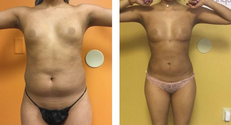 Fat-Transfer
