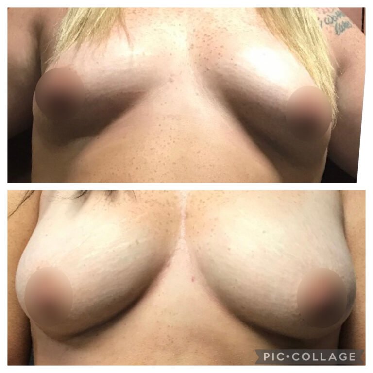 Fat Transfer