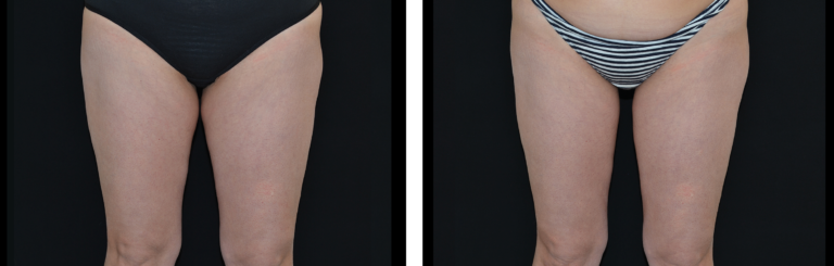 Exilis