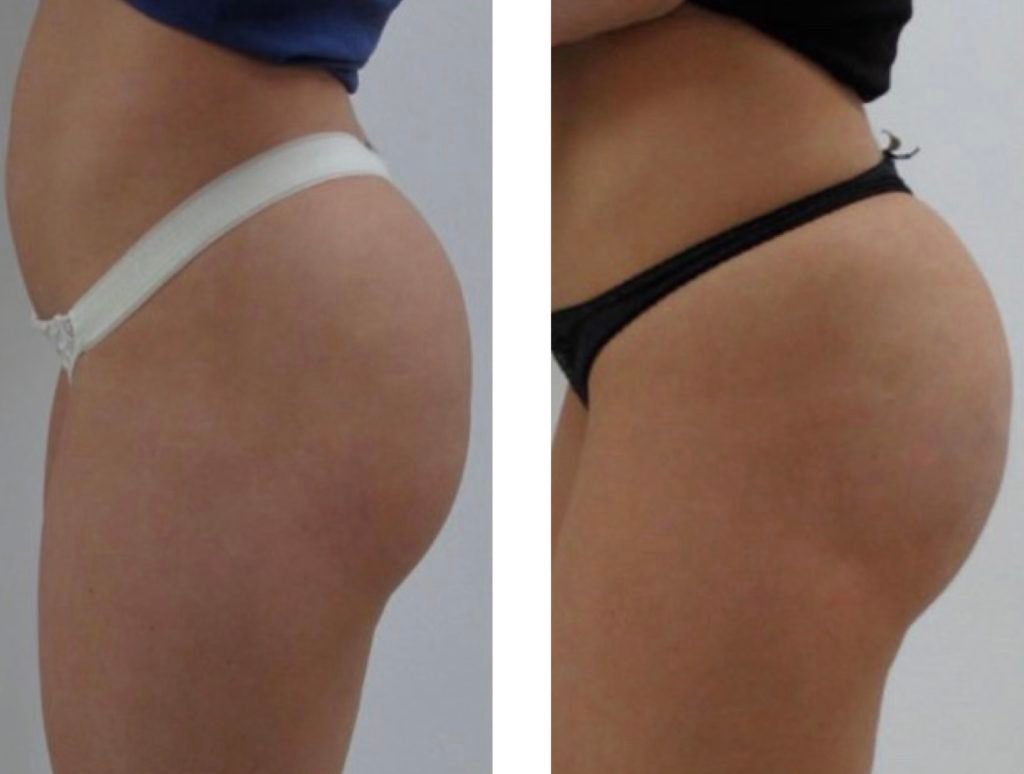 fat-Transfer-6M-after