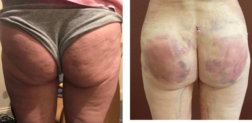 fat-transfer-2-days-after