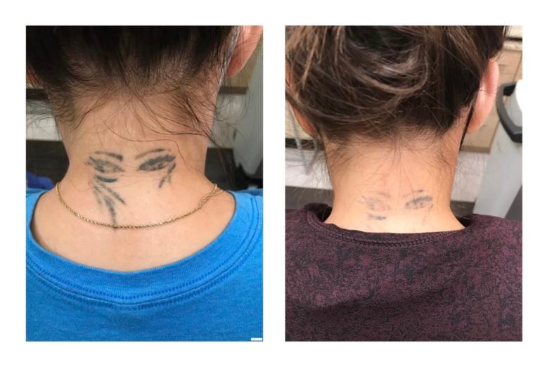 tatoo-removal-after